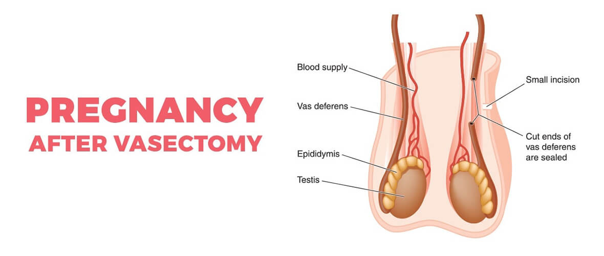 Pregnancy after vasectomy